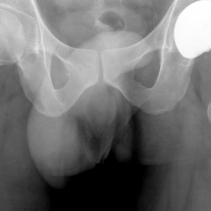 Do I need a hip replacement