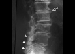 Spondylosis
